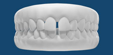 Un diastema dental es mucho más que un simple espacio entre los dientes. Se refiere a la separación notable entre dos dientes, comúnmente asociada con el espacio entre los dos dientes frontales superiores, pero también puede ocurrir en otros lugares de la boca. Este fenómeno puede ser causado por varios factores, como el tamaño desproporcionado de los dientes, la pérdida de dientes, la discrepancia entre el tamaño de los dientes y la mandíbula, o ciertos hábitos como chuparse el pulgar.

Aunque algunos pueden ver el diastema como un rasgo estético único, puede plantear preocupaciones funcionales y de salud oral. Por ejemplo, puede dificultar la masticación y la pronunciación, así como aumentar el riesgo de enfermedades de las encías y la caries debido a la acumulación de alimentos y placa entre los dientes separados.

Es importante comprender que el diastema dental puede abordarse mediante diversas opciones de tratamiento, que van desde la ortodoncia hasta procedimientos cosméticos como las carillas dentales. Sin embargo, antes de optar por cualquier intervención, es crucial consultar con un dentista para evaluar la causa subyacente del diastema y determinar el enfoque más adecuado para abordarlo.

En última instancia, comprender el significado del diastema dental va más allá de su apariencia física; implica considerar su impacto en la función oral y la salud bucal en general, y buscar soluciones que promuevan una sonrisa saludable y armoniosa.