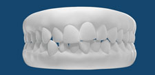 Los dientes apiñados son más que una cuestión estética; representan un desafío funcional y una preocupación de salud oral. Cuando los dientes están apiñados, se amontonan unos sobre otros, lo que puede dificultar la higiene adecuada, aumentando el riesgo de caries, enfermedad de las encías y otros problemas bucales. Además, el apiñamiento puede afectar la alineación de la mandíbula y provocar molestias en la masticación y el habla. Afortunadamente, con opciones como la ortodoncia, es posible corregir el apiñamiento dental, no solo mejorando la estética sino también la salud y el bienestar general.